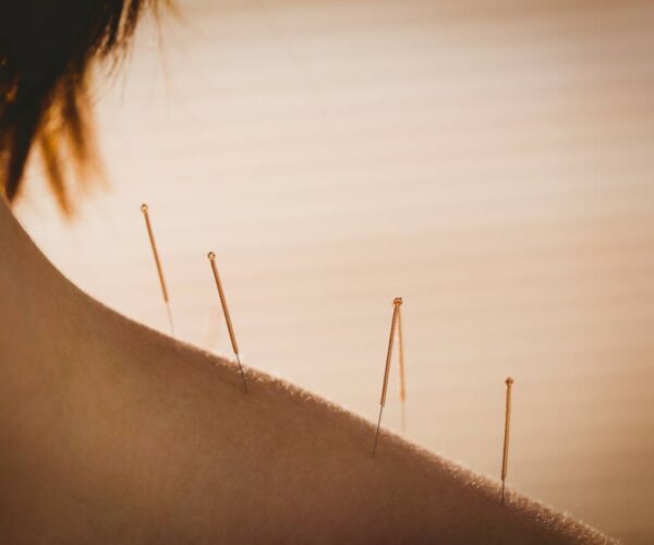 What is the history behind acupuncture? How does acupuncture work? Is acupuncture safe?